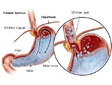 Mide Reflüsü Tedavisi