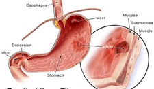 Mide Çıkışında Daralma Nedenleri ve Tedavisi